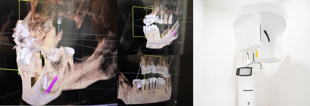 歯科用CTスキャン